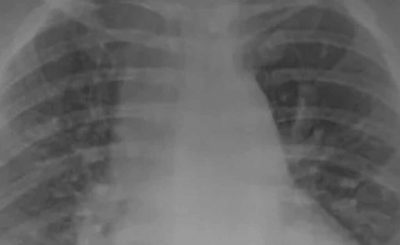 To zdjęcie RTG przedstawia płuca osób chorujących na COVID-19. Zasadnicza różnica jest taka, że jeden z pacjentów jest zaszczepiony